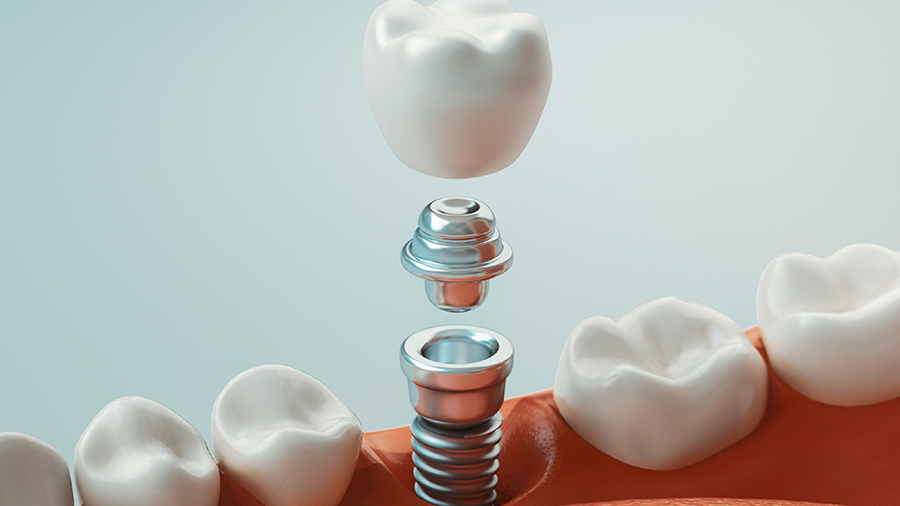 Dental implant dentists in Ada MI