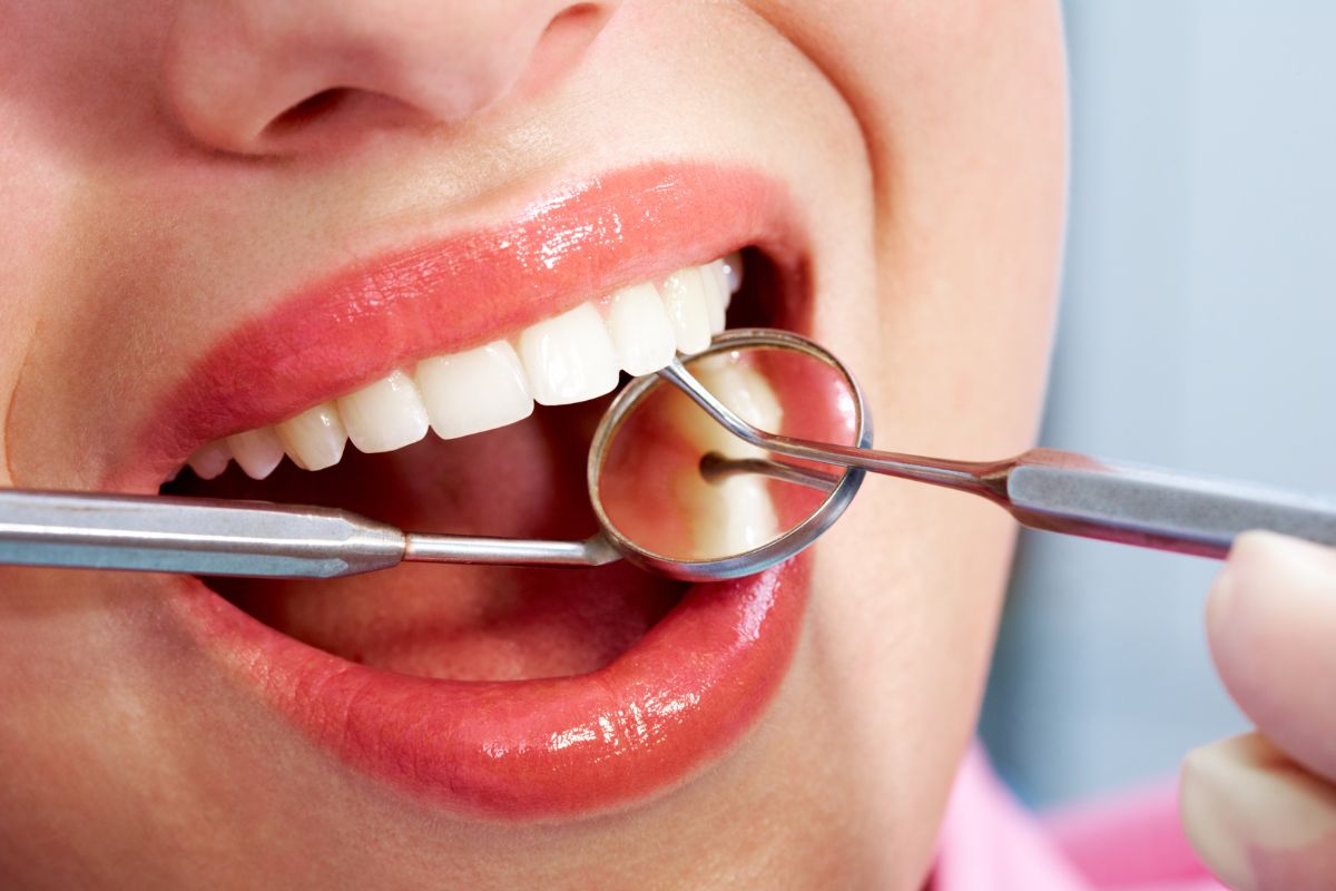 How Do Dental Sealants Prevent Tooth Decay?