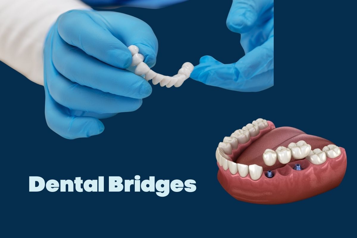 Types of Dental Bridges: Traditional, Cantilever, Maryland, and Implant-Supported