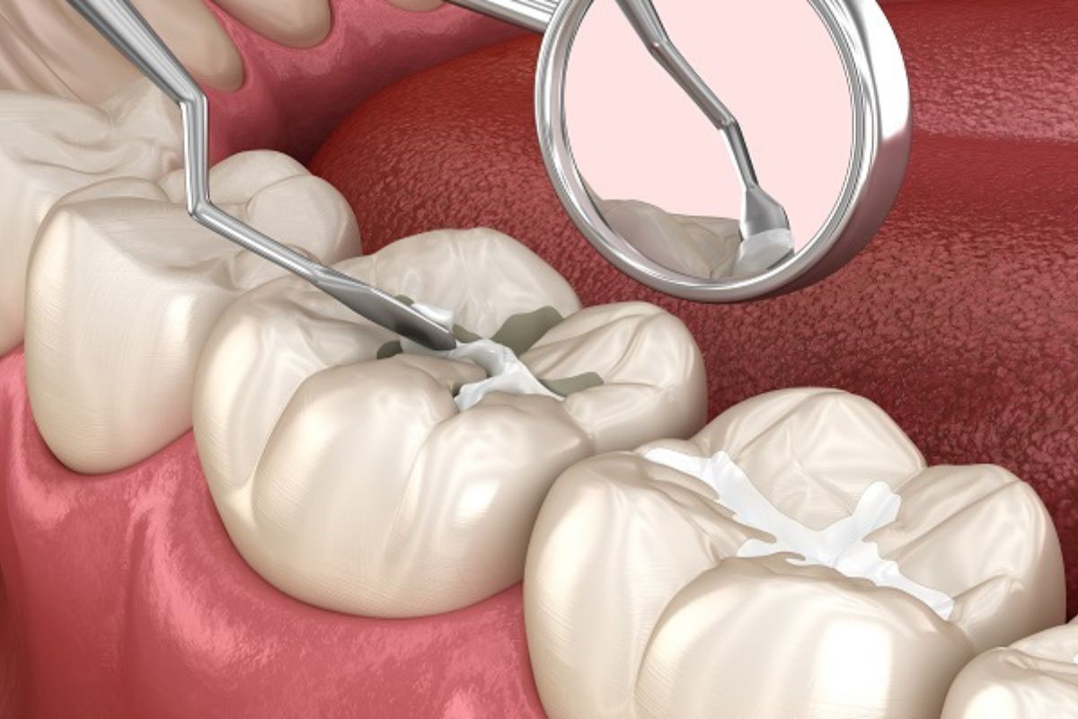 Dental Sealants: What Are They and How Long Do They Last?