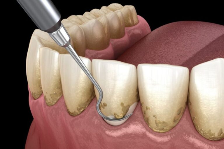 "Cavities