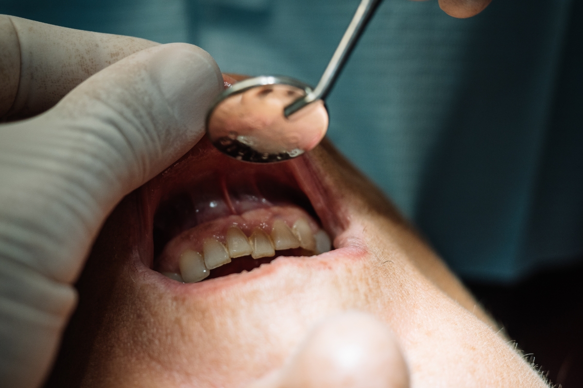 The Truth About Tartar: Why Professional Dental Cleaning Is Essential