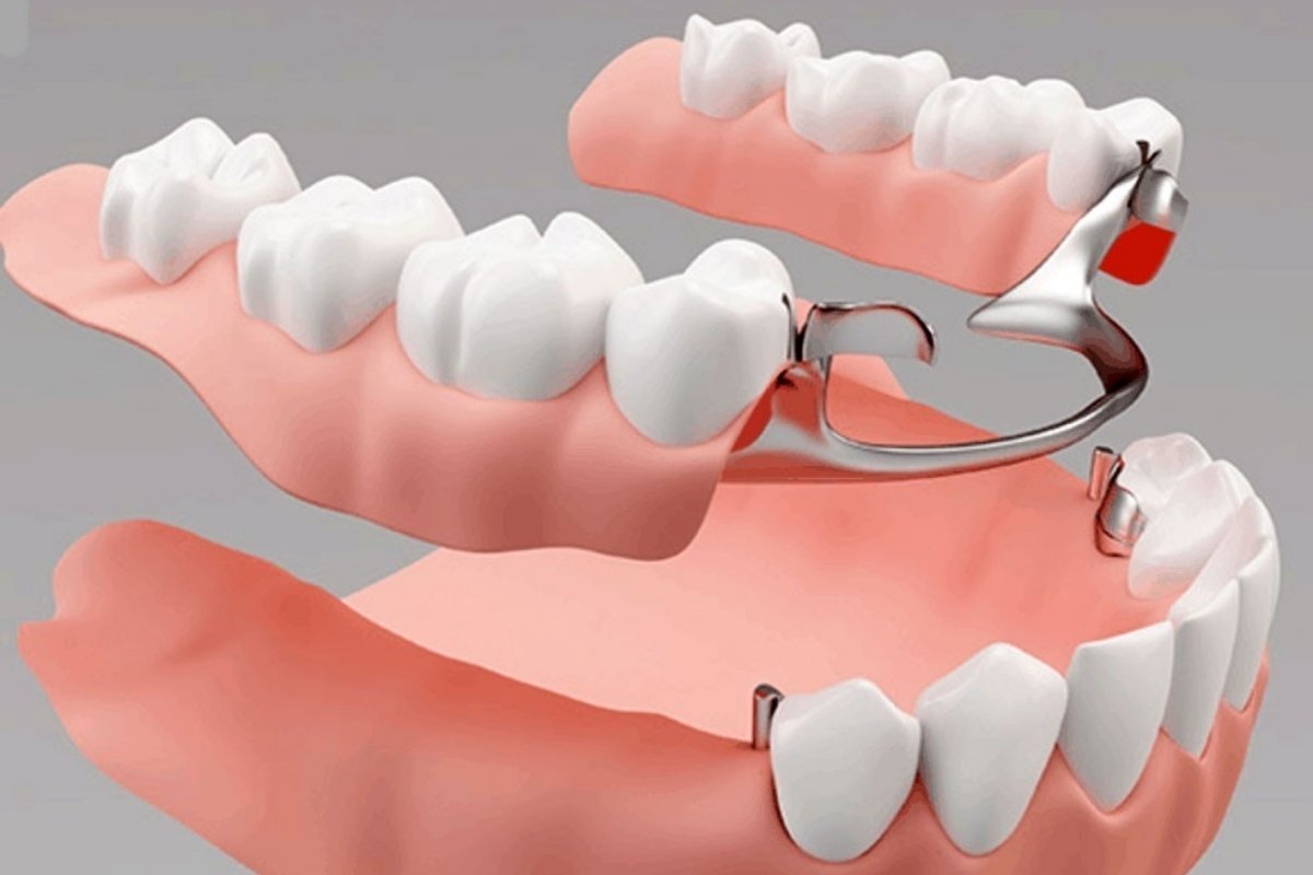 Understanding Complete Dentures: Benefits, Care, and What to Expect
