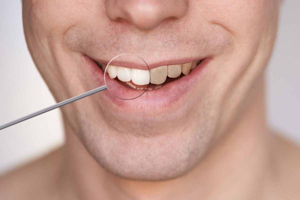 Is Cosmetic Bonding Right for You? A Dentist’s Guide to Smile Enhancement