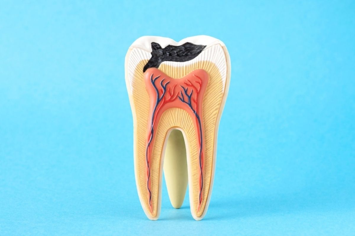 Emergency Treatments for Severely Decayed Teeth: Root Canal, Crown, or Extraction?