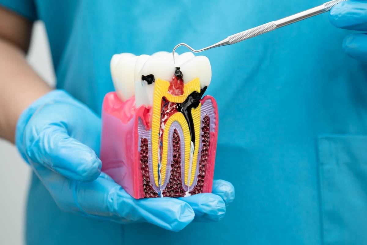 Signs You Might Need a Root Canal: Identifying Tooth Pulp Infections Early