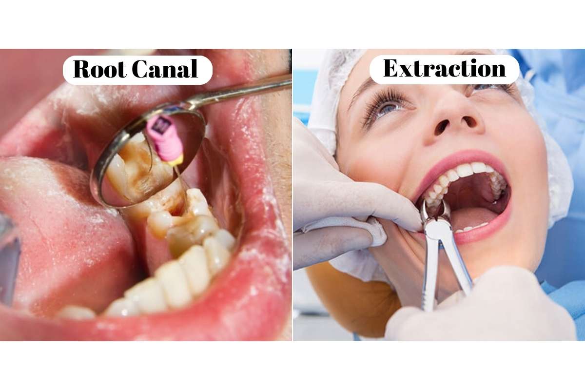 Root Canal vs. Tooth Extraction: Which Option Is Right for You?