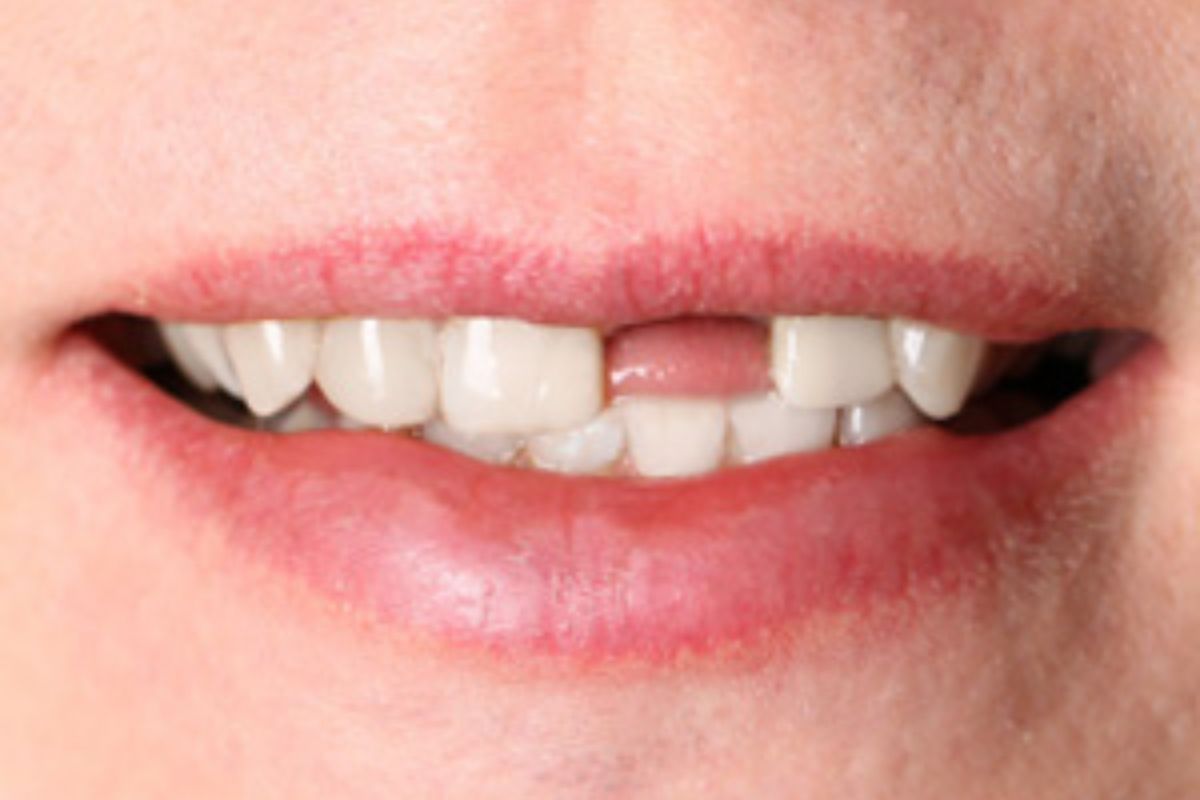 6 Tooth Replacement Options Your Dentist May Recommend