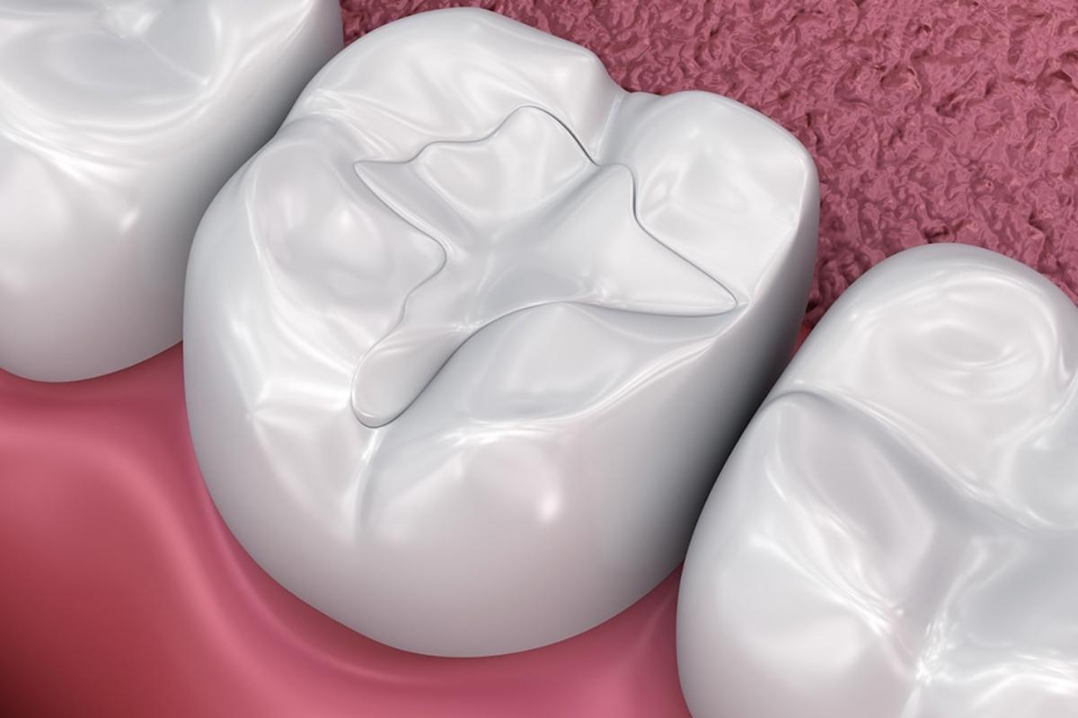 Dental Sealants for Adults: Are They Worth It?
