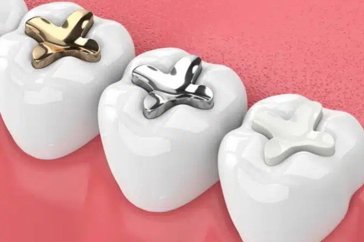 What Are Dental Fillings, and When Are They Necessary?