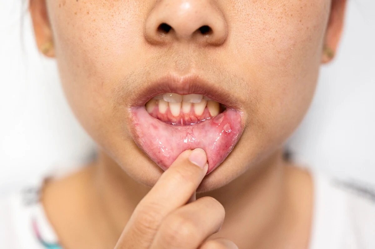 Is It a Canker Sore? How to Identify, Treat, and Prevent Oral Lesions in Kids